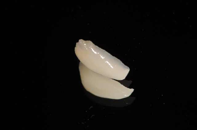 ラミネートベニア