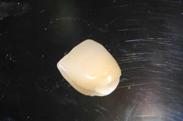 オールセラミッククラウン