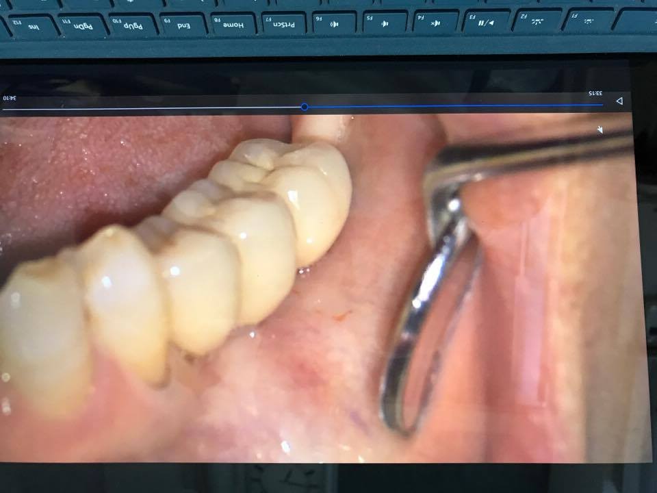 歯ぐきが歯磨きで痛い・物が詰まる