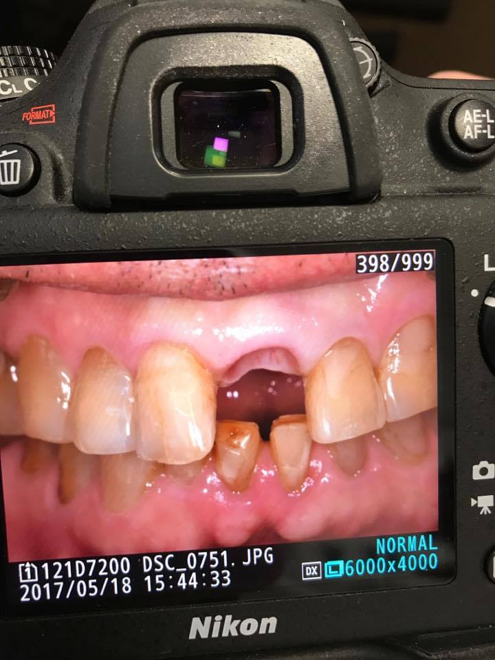 審美インプラント・研修会参加報告