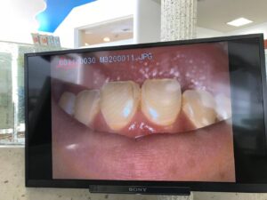 ダイレクトレストレーション コンポジットレジン充填