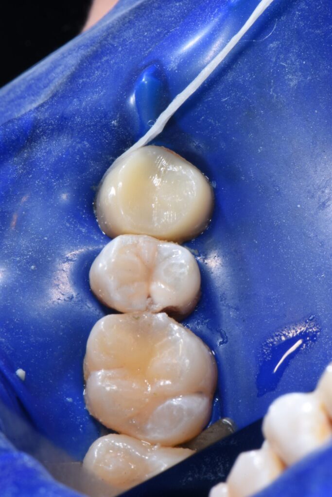 宇部市歯医者 ラバーダム防湿