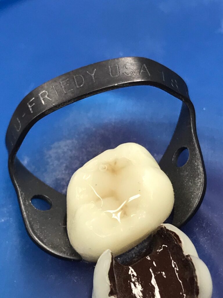 宇部市歯医者 ダイレクトボンディングセミナーin東京