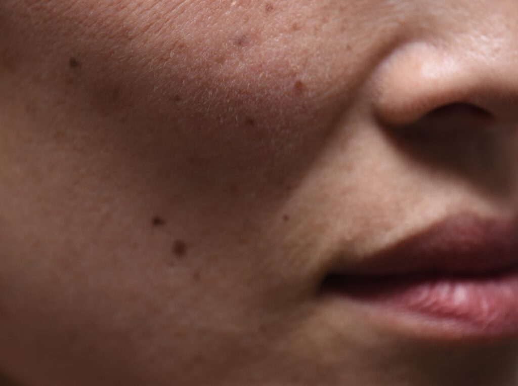 ほうれい線やマリオネットラインへのヒアルロン酸注射