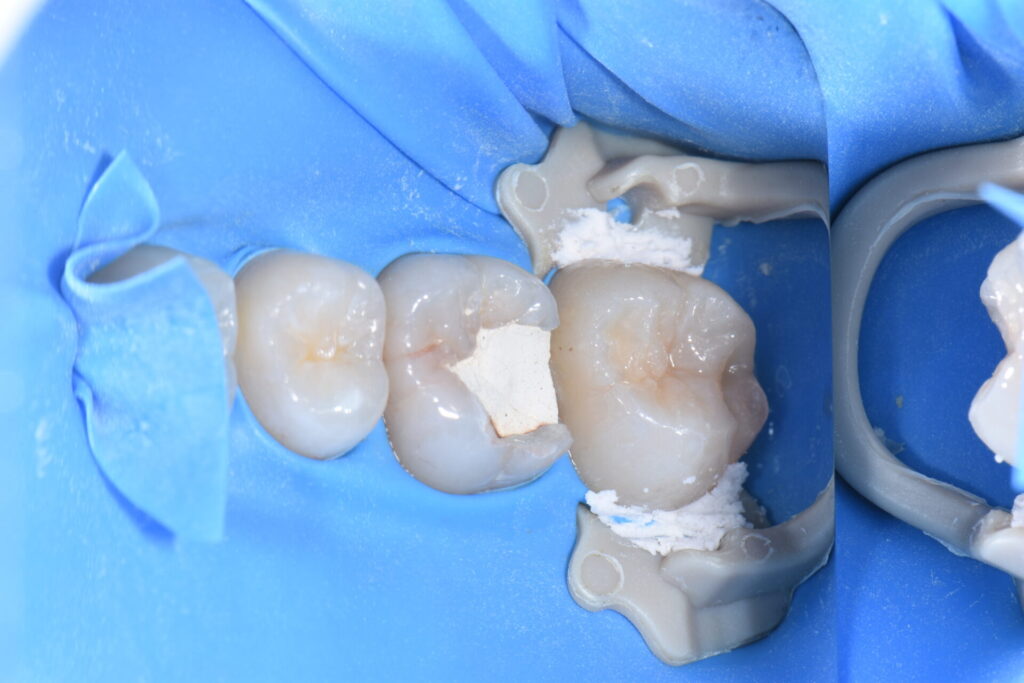 宇部市歯医者　MTA　歯の神経を取らない治療法　ダイレクトボンディング　白い歯