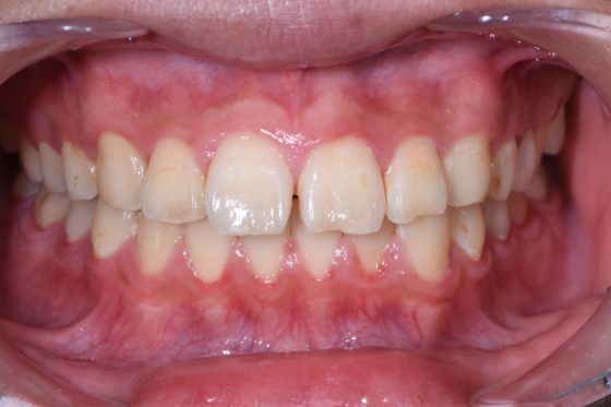 宇部市歯医者 前歯のすきっ歯 正中離開 ダイレクトボンディング 白い歯