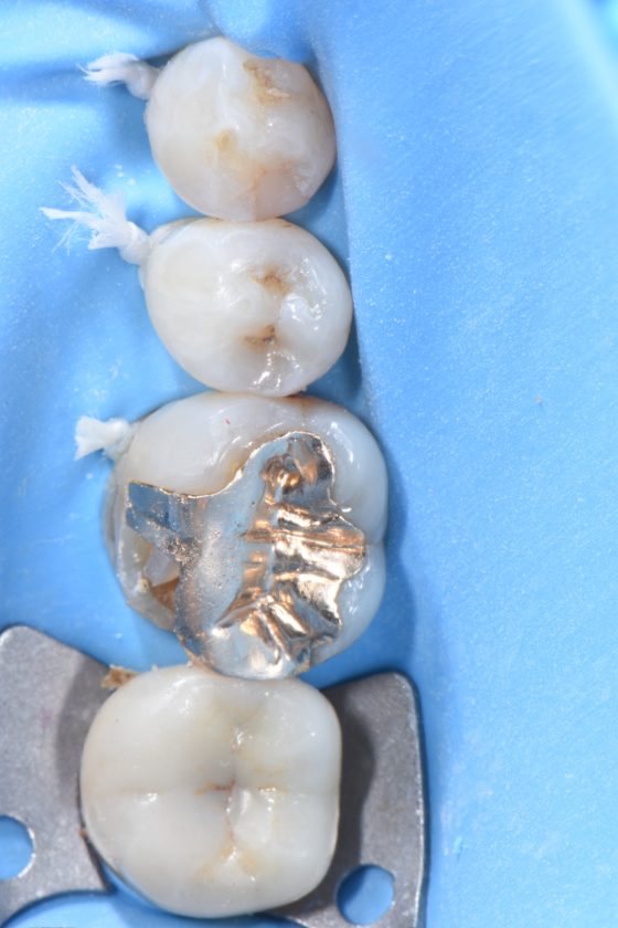 宇部市歯科　セラミックオンレー　ラバーダム　白い歯