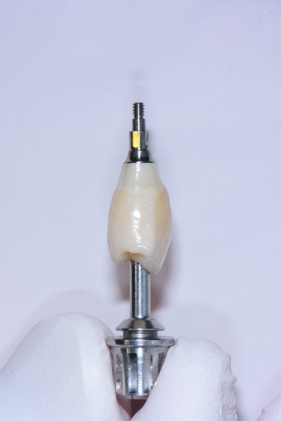 宇部市歯医者 インプラント治療 歯根破折 咬めない