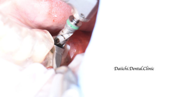 インプラント治療について　宇部市歯医者