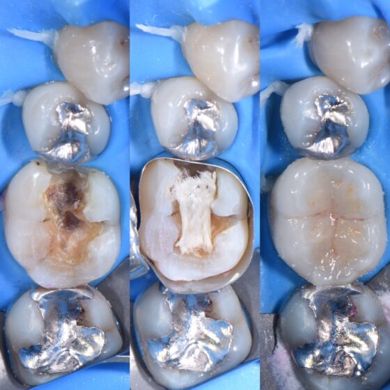 宇部市歯医者ブログ　ラバーダム防湿下で歯の神経を残すセラミック治療