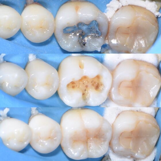 宇部市歯科ブログ　銀歯を白い歯に変えたい　ラバーダム　ダイレクトボンディング