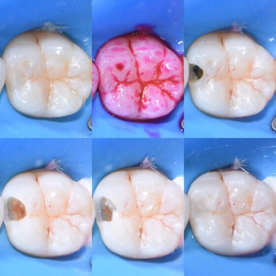 宇部市歯医者　ラバーダムを使用したダイレクトボンディング　虫歯治療