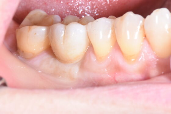 宇部市　歯医者　歯根嚢胞で失った奥歯にインプラント治療