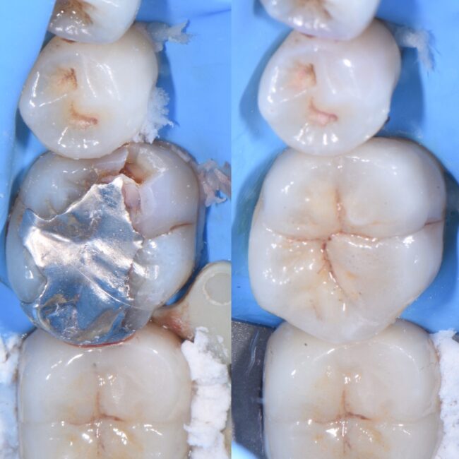 宇部市歯医者　ラバーダム防湿　セラミック治療　歯の神経を守る