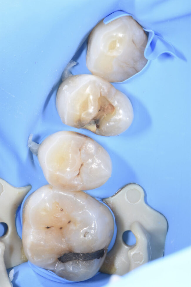 宇部市歯医者ブログ　ラバーダム防湿とダイレクトボンディング　白い歯　歯ぎしり　虫歯治療