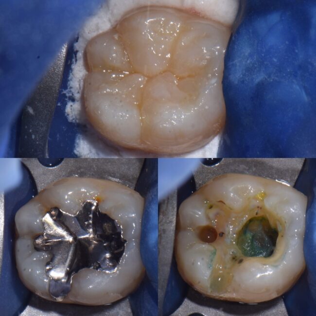 宇部市歯医者　虫歯治療をラバーダム防湿下で行いました。歯の神経を守る治療
