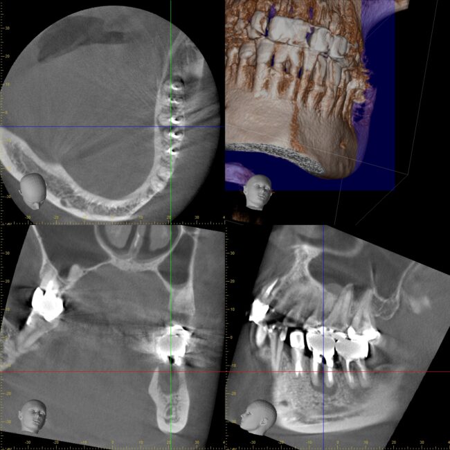 専門医が行う根管治療① 3DCTの有用性　〜宇部市歯医者（歯の神経の治療）