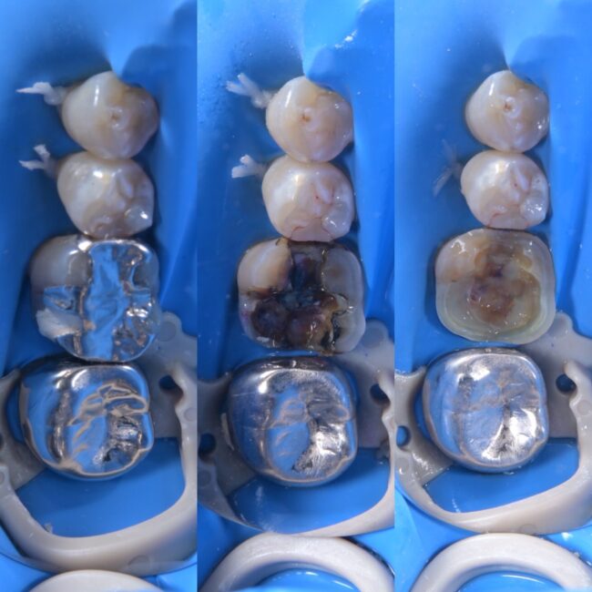 歯が欠けた・銀歯が取れた場合にラバーダムを使った歯科治療〜宇部市歯医者ブログ