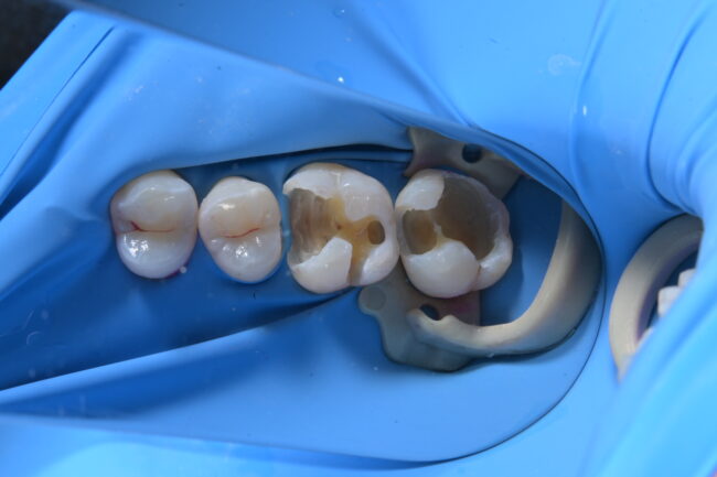 ラバーダムを用いた歯科治療〜宇部市歯医者